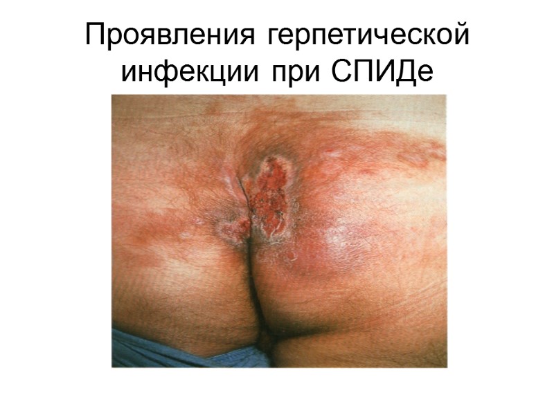 Проявления герпетической инфекции при СПИДе